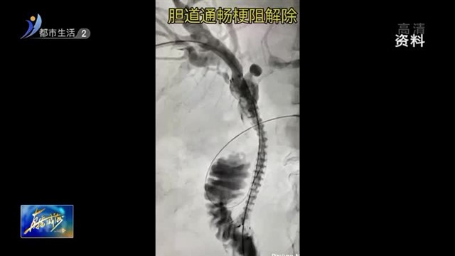 胆道内支架“套娃” 老人顺利解除插管痛苦