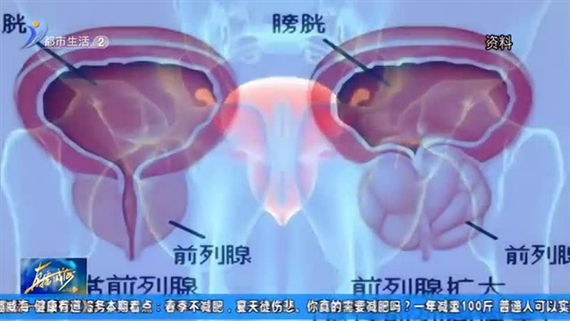 50%男性都会中招的“前列腺炎”，究竟是怎么回事？【威海广电讯】