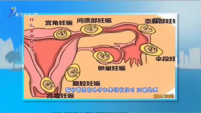 健康在身边：什么是宫外孕？【威海广电讯】