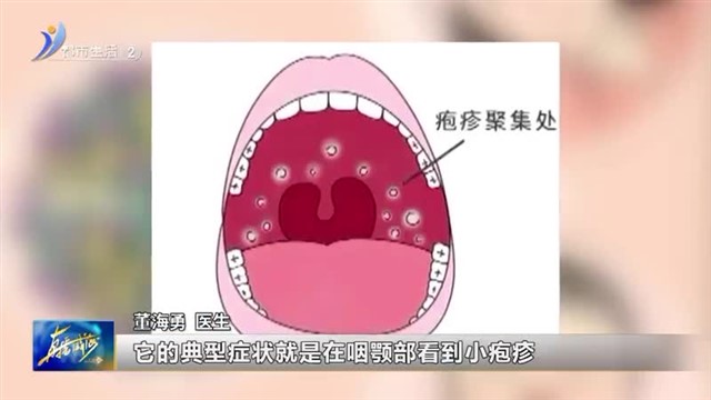 喉咙长“泡泡”当心疱疹性咽峡炎【威海广电讯】