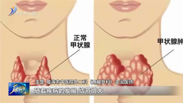 千万别忽视！结节性甲状腺肿和它密切相关【威海广电讯】